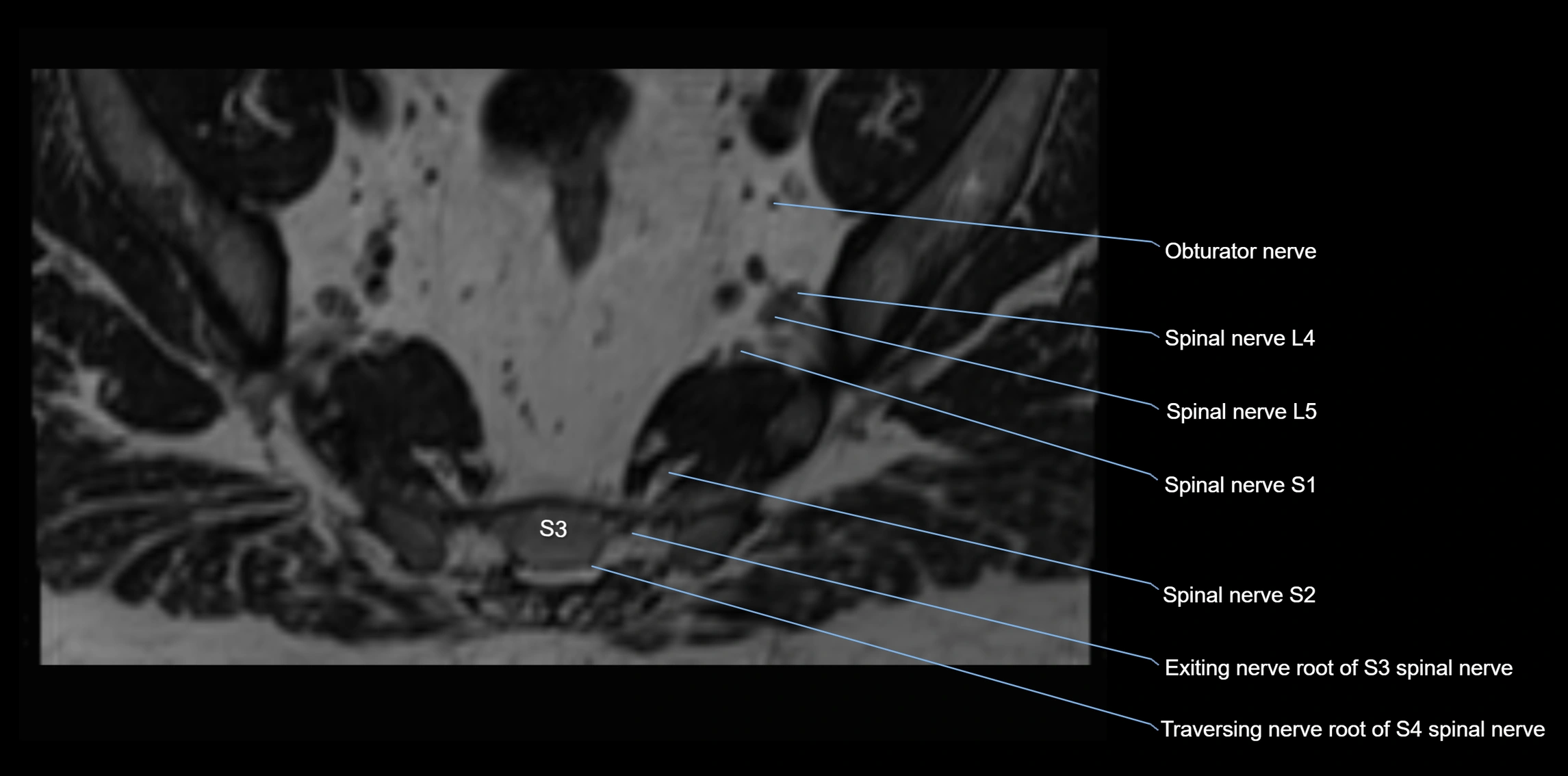 MR lumbosacral plexus axial cross sectional anatomy 3T  radiology  image-img-1008001-00093.webp